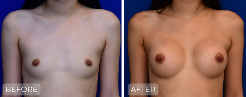 Dr. John Park MD: Breast | Patient 1 - Thumbnail
