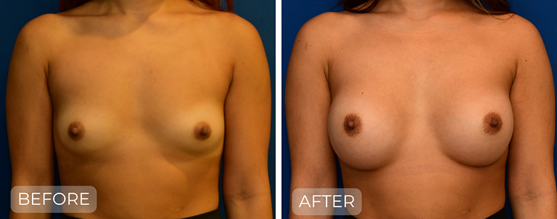 Dr. John Park MD: Breast | Patient 10 - Thumbnail