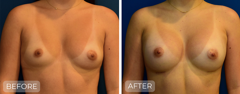Dr. John Park MD: Breast | Patient 11 - Thumbnail