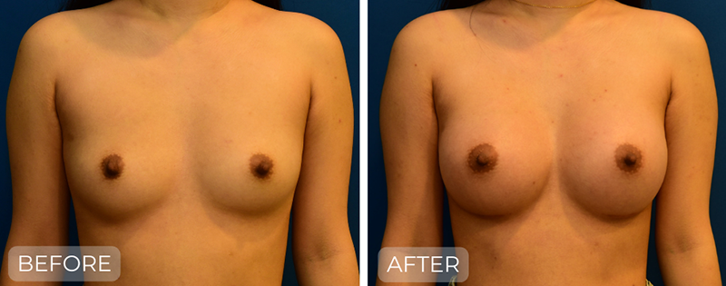 Dr. John Park MD: Breast | Patient 2 - Thumbnail