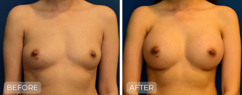 Dr. John Park MD: Breast | Patient 3 - Thumbnail