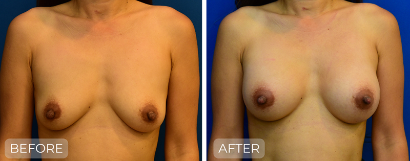 Dr. John Park MD: Breast | Patient 4 - Thumbnail