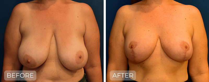 Dr. John Park MD: Breast | Patient 5 - Thumbnail