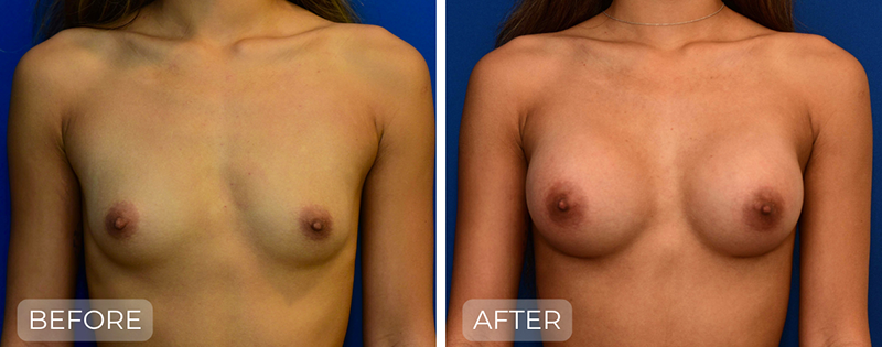 Dr. John Park MD: Breast | Patient 6 - Thumbnail