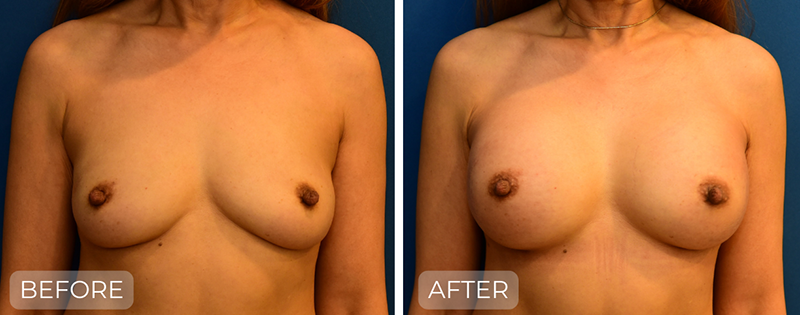 Dr. John Park MD: Breast | Patient 7 - Thumbnail