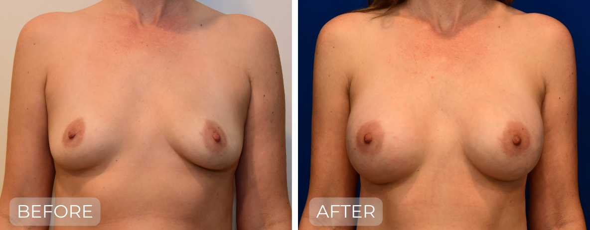 Dr. John Park MD: Breast | Patient 8 - Thumbnail
