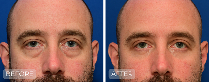 Dr. John Park MD: Face / Eyelids | Patient 1 - Thumbnail