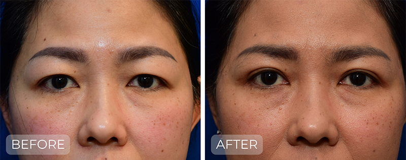 Dr. John Park MD: Face / Eyelids | Patient 10 - Thumbnail