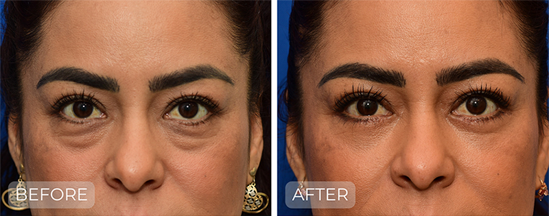 Dr. John Park MD: Face / Eyelids | Patient 11 - Thumbnail