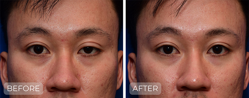 Dr. John Park MD: Face / Eyelids | Patient 12 - Thumbnail