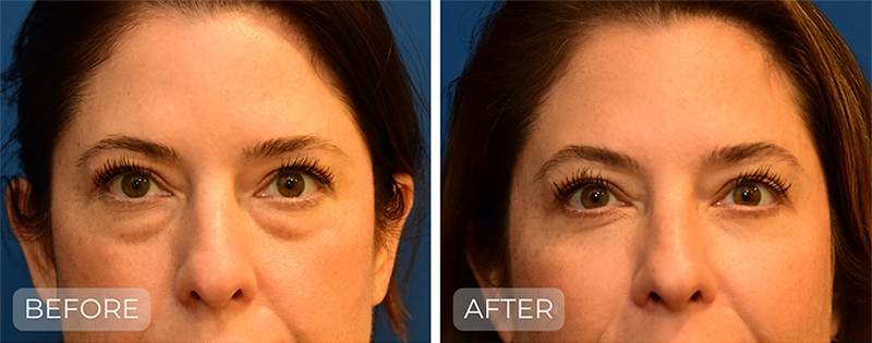 Dr. John Park MD: Face / Eyelids | Patient 13 - Thumbnail