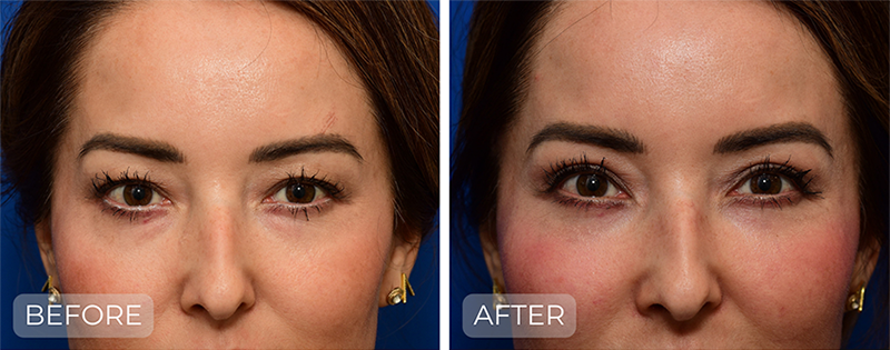 Dr. John Park MD: Face / Eyelids | Patient 14 - Thumbnail