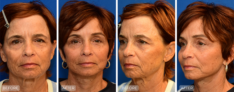 Dr. John Park MD: Face / Eyelids | Patient 15 - Thumbnail