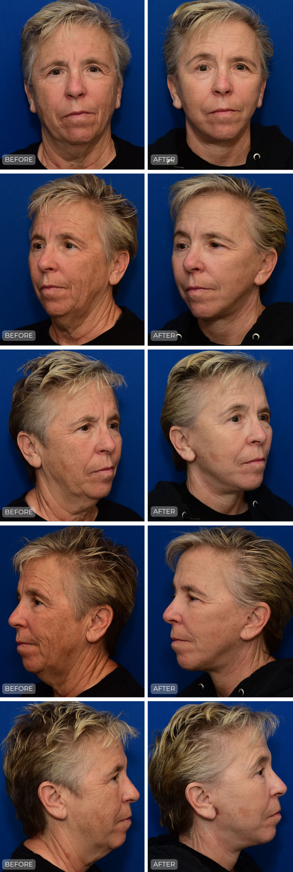 Dr. John Park MD: Face / Eyelids | Patient 16 - Dedicated Page