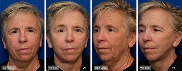 Dr. John Park MD: Face / Eyelids | Patient 16 - Thumbnail
