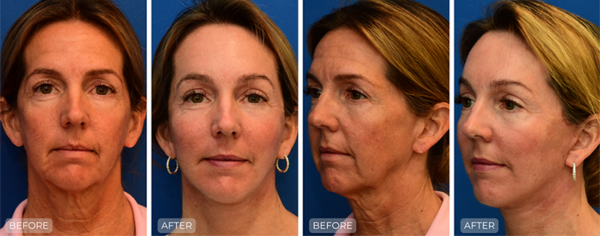 Dr. John Park MD: Face / Eyelids | Patient 17 - Thumbnail