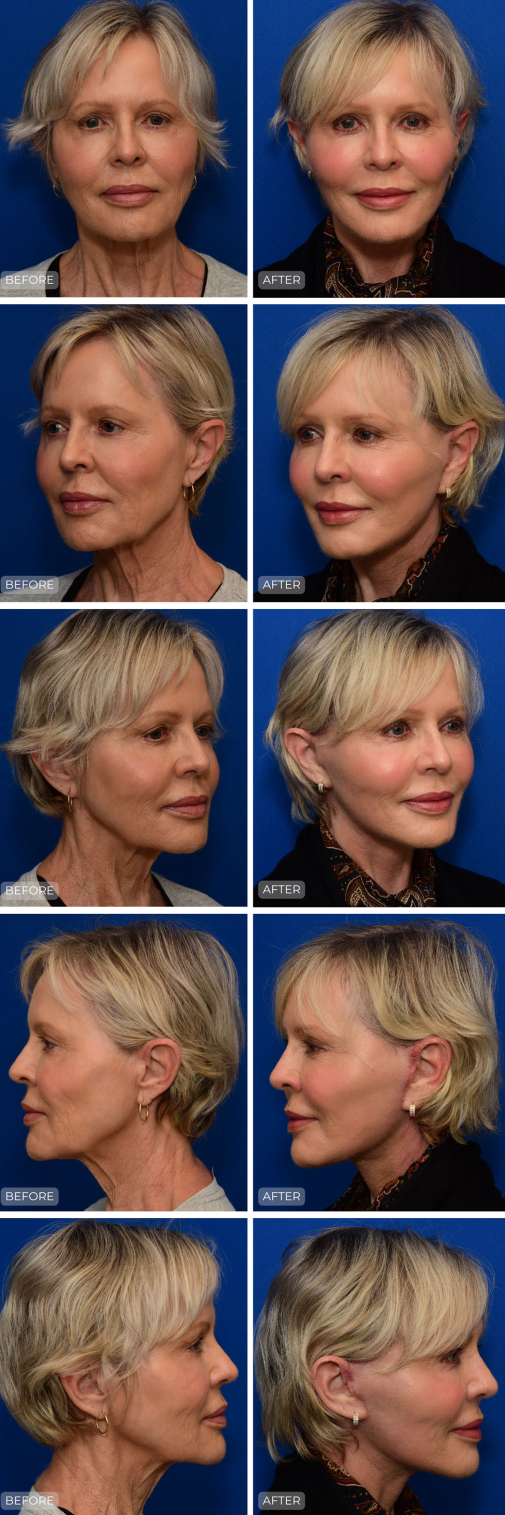 Dr. John Park MD: Face / Eyelids | Patient 18 - Dedicated Page