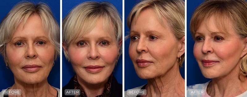 Dr. John Park MD: Face / Eyelids | Patient 18 - Thumbnail