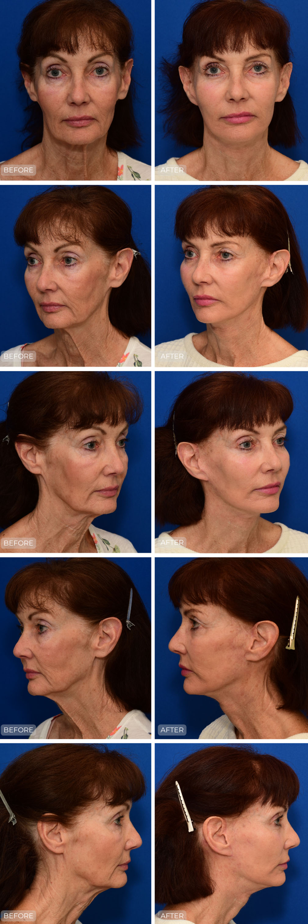 Dr. John Park MD: Face / Eyelids | Patient 19 - Dedicated Page