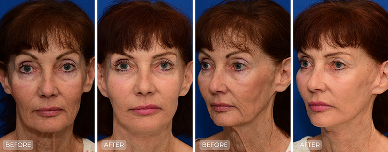 Dr. John Park MD: Face / Eyelids | Patient 19 - Thumbnail