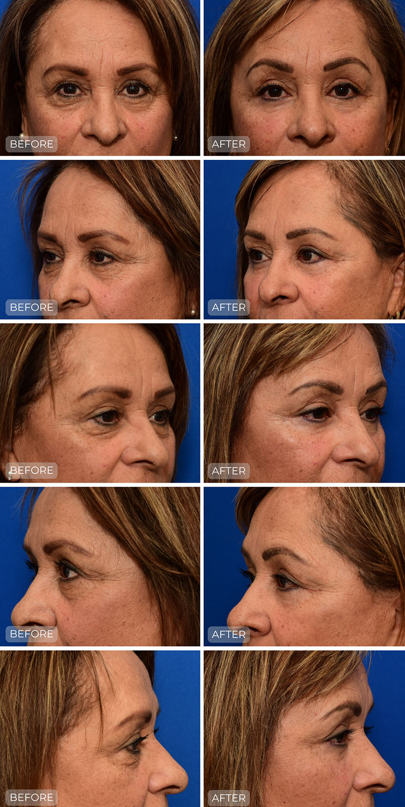 Dr. John Park MD: Face / Eyelids | Patient 2 - Dedicated Page