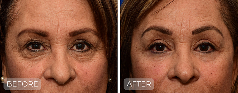 Dr. John Park MD: Face / Eyelids | Patient 2 - Thumbnail