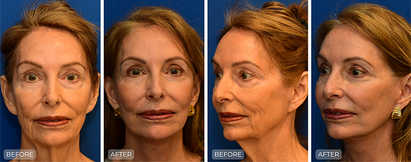 Dr. John Park MD: Face / Eyelids | Patient 20 - Thumbnail