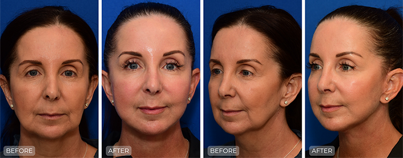 Dr. John Park MD: Face / Eyelids | Patient 21 - Thumbnail