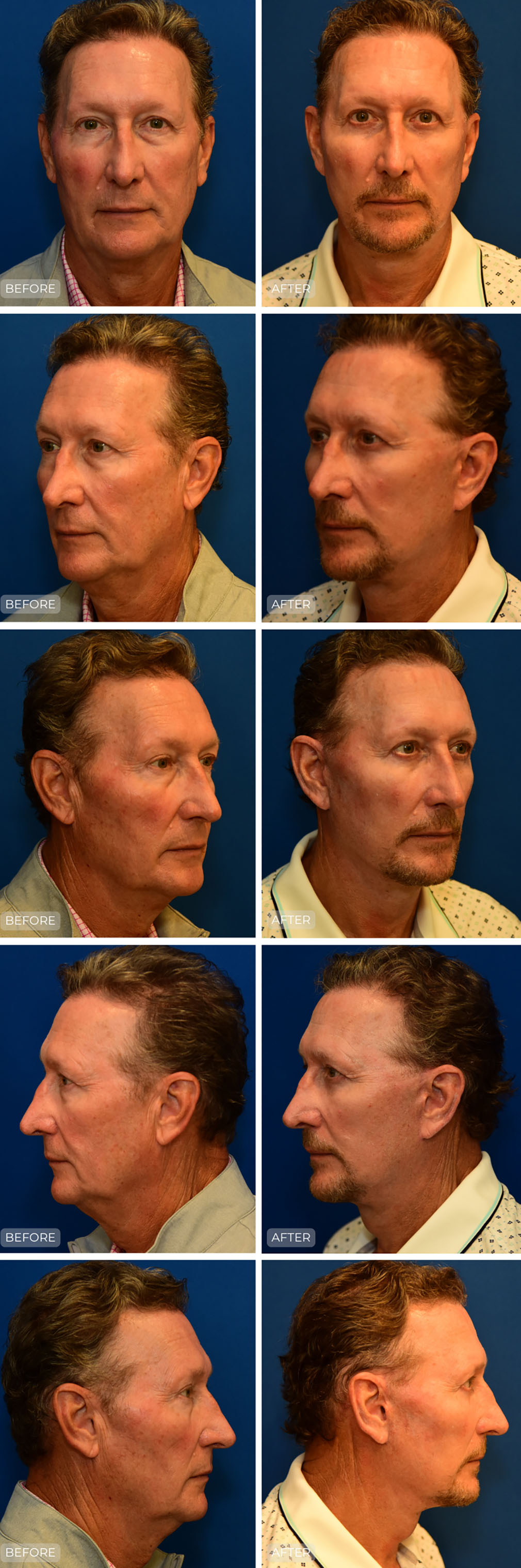 Dr. John Park MD: Face / Eyelids | Patient 22 - Dedicated Page