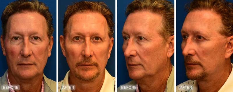Dr. John Park MD: Face / Eyelids | Patient 22 - Thumbnail