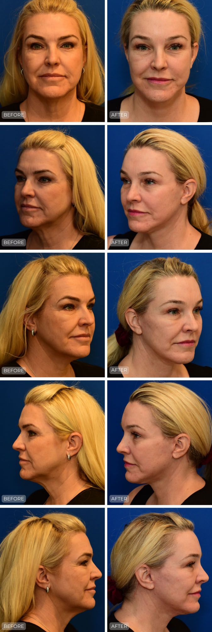Dr. John Park MD: Face / Eyelids | Patient 23 - Dedicated Page