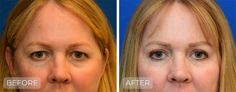 Dr. John Park MD: Face / Eyelids | Patient 3 - Thumbnail