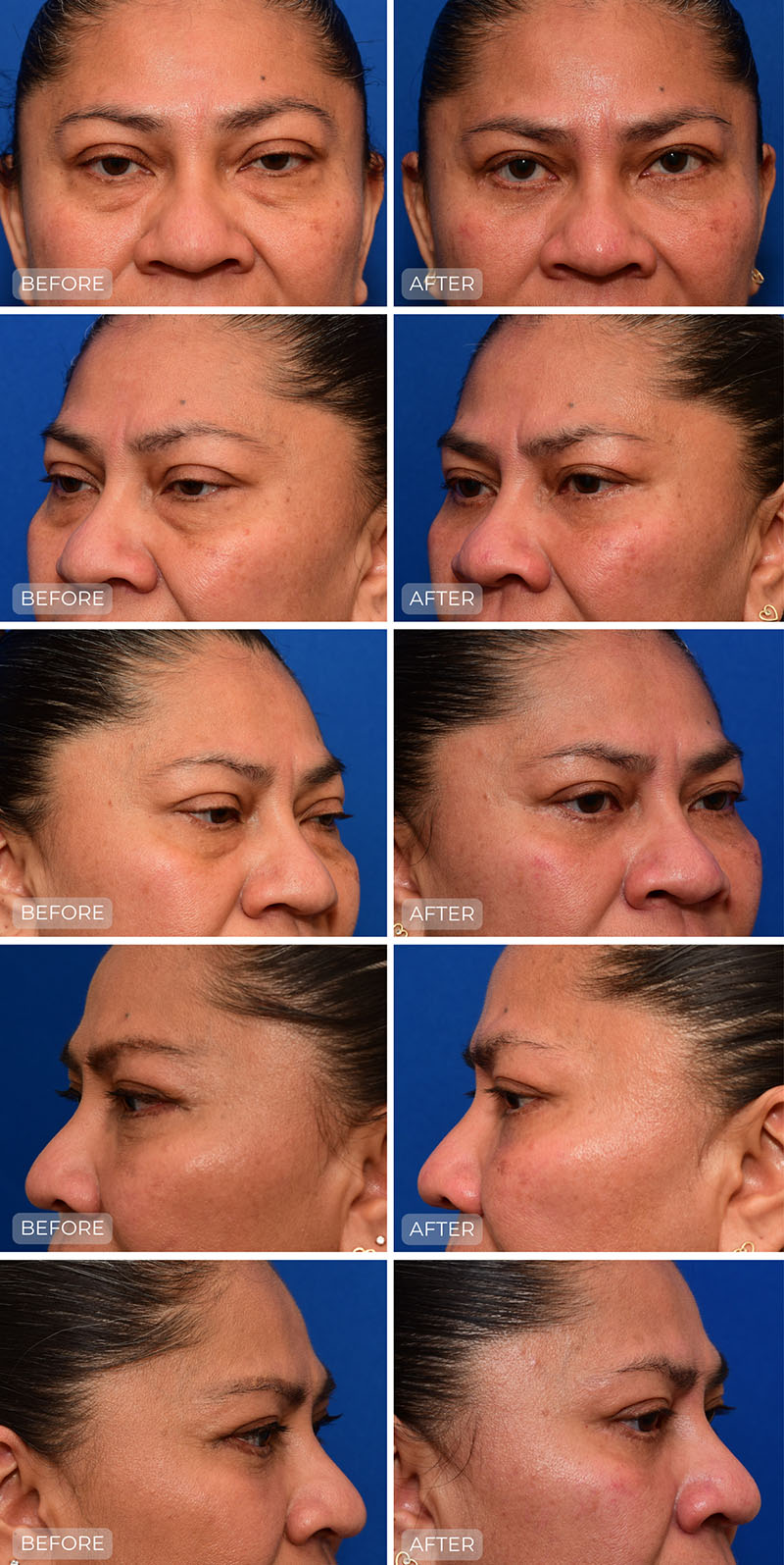 Dr. John Park MD: Face / Eyelids | Patient 4 - Dedicated Page