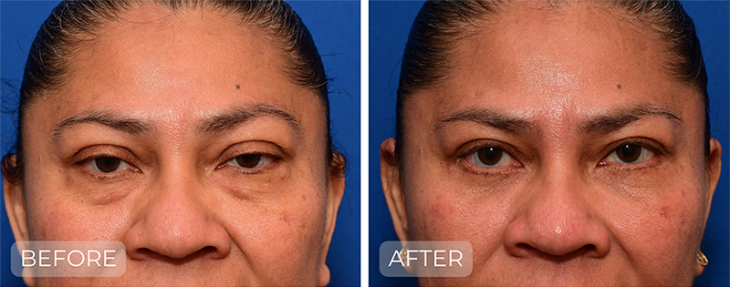 Dr. John Park MD: Face / Eyelids | Patient 4 - Thumbnail