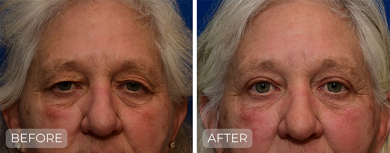 Dr. John Park MD: Face / Eyelids | Patient 5 - Thumbnail