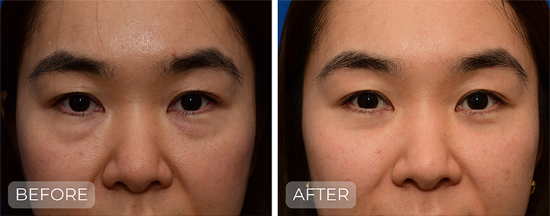 Dr. John Park MD: Face / Eyelids | Patient 6 - Thumbnail