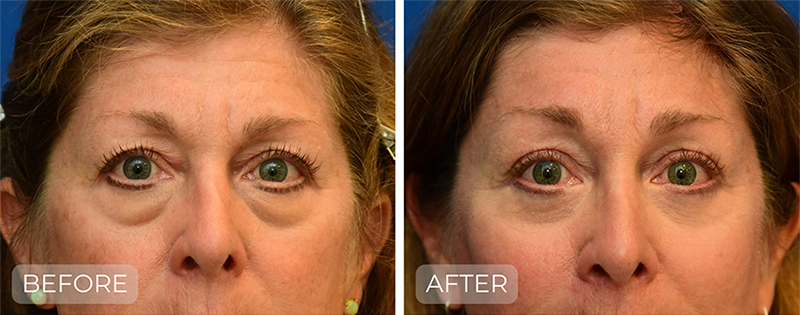 Dr. John Park MD: Face / Eyelids | Patient 7 - Thumbnail