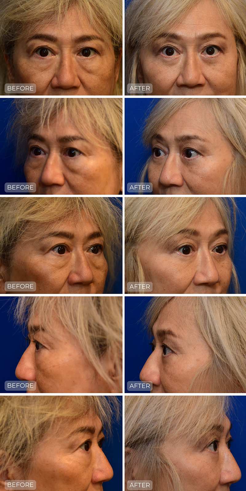 Dr. John Park MD: Face / Eyelids | Patient 8 - Dedicated Page