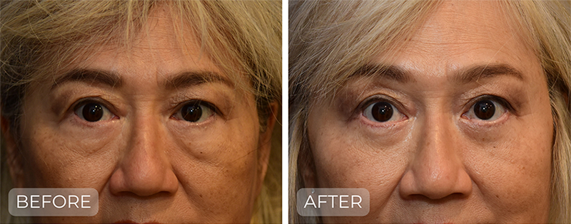 Dr. John Park MD: Face / Eyelids | Patient 8 - Thumbnail