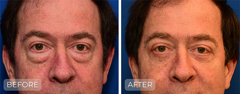Dr. John Park MD: Face / Eyelids | Patient 9 - Thumbnail