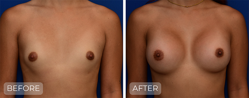 Dr. John Park MD: Breast | Patient 12 - Thumbnail