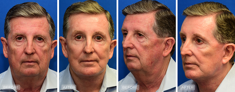 Dr. John Park MD: Face / Eyelids | Patient 24 - Thumbnail
