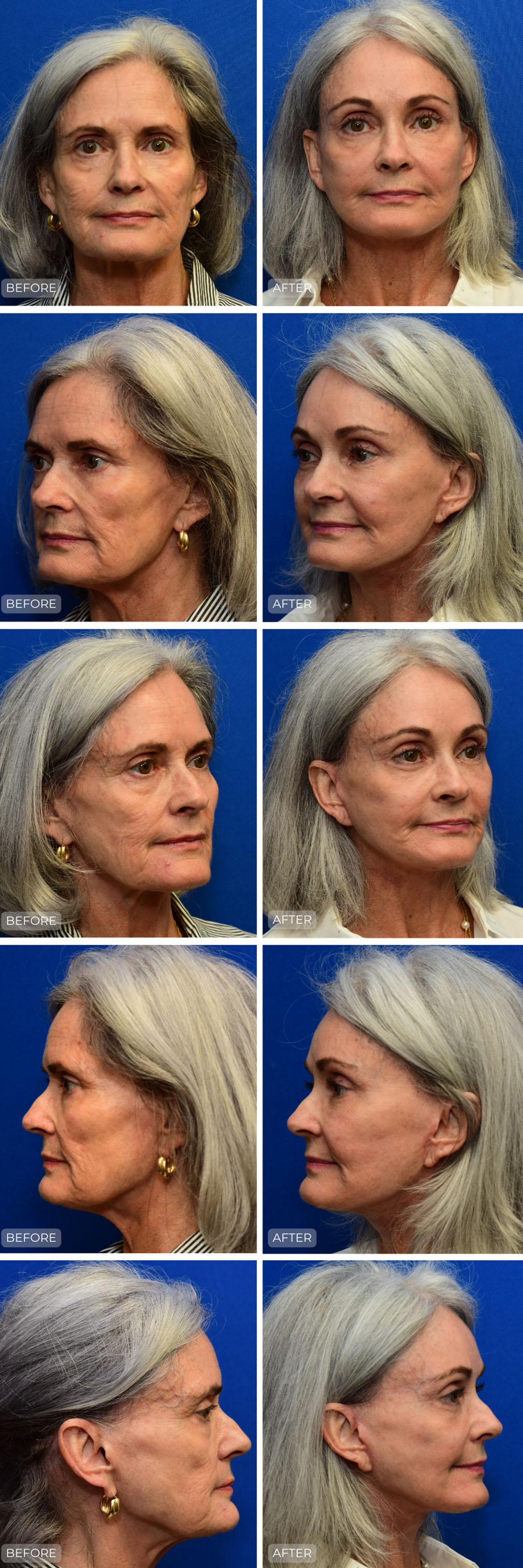 Dr. John Park MD: Face / Eyelids | Patient 25 - Dedicated Page