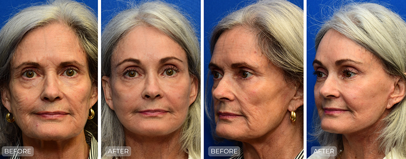 Dr. John Park MD: Face / Eyelids | Patient 25 - Thumbnail
