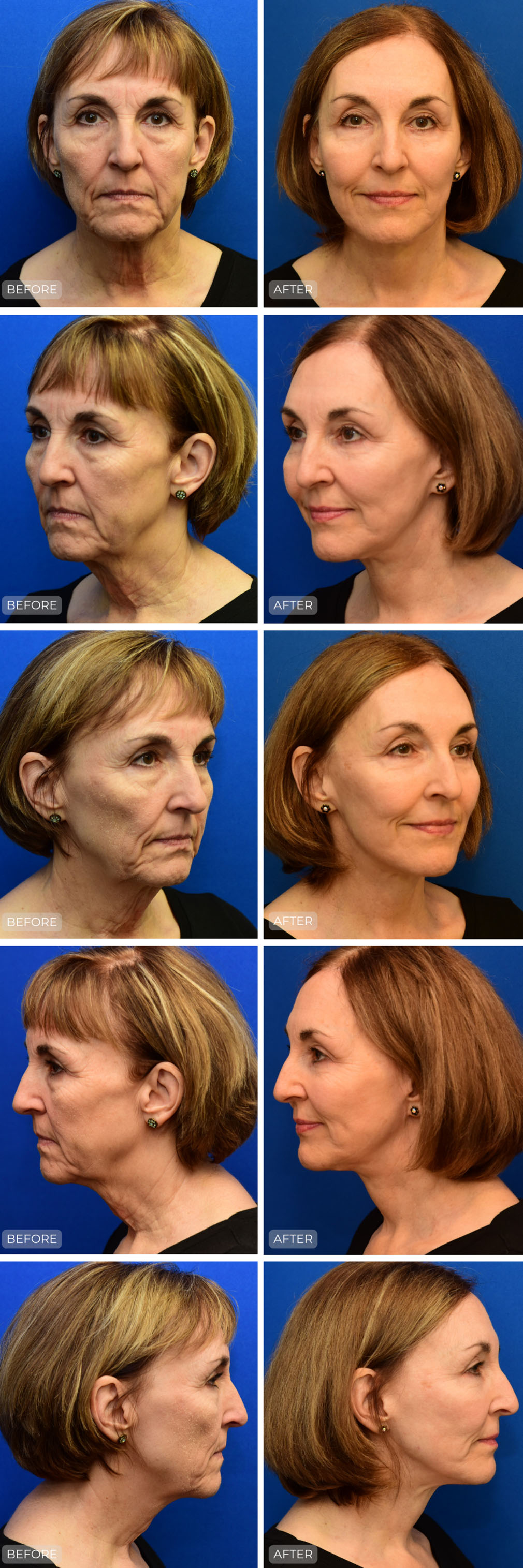 Dr. John Park MD: Face / Eyelids | Patient 26 - Dedicated Page