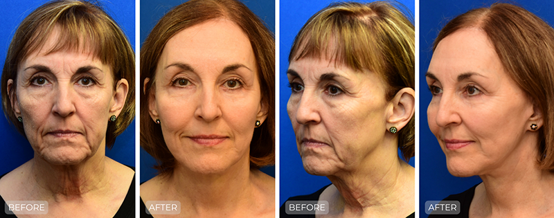 Dr. John Park MD: Face / Eyelids | Patient 26 - Thumbnail