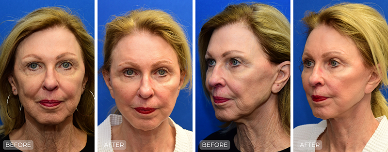 Dr. John Park MD: Face / Eyelids | Patient 27 - Thumbnail