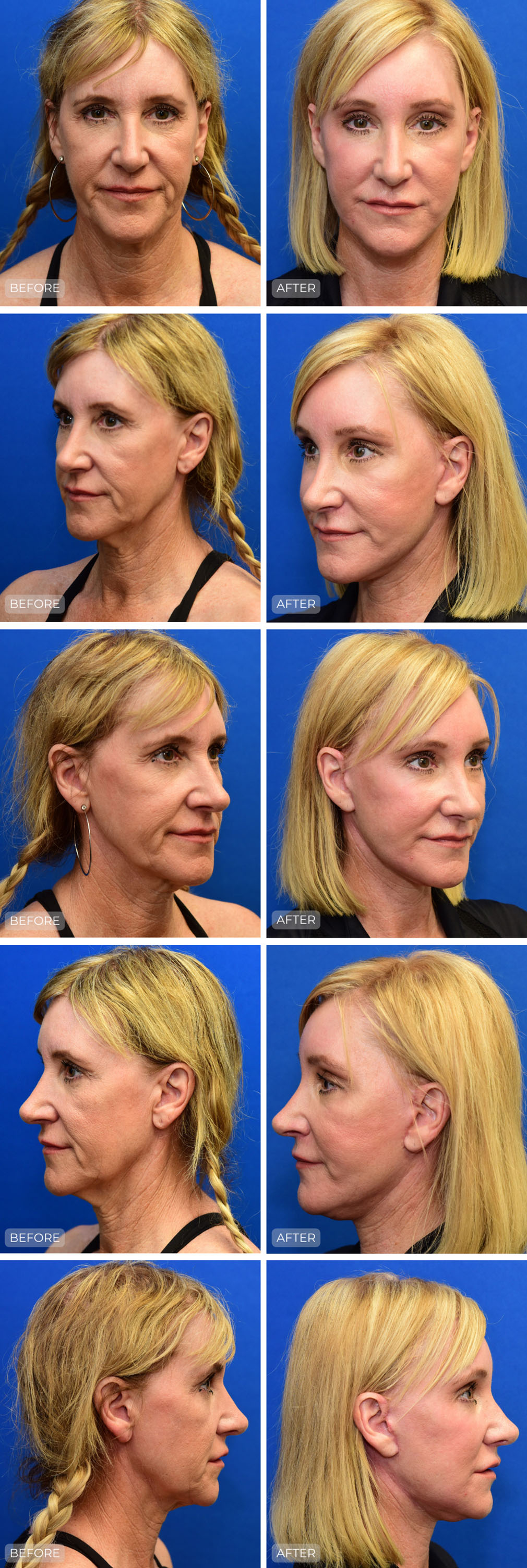 Dr. John Park MD: Face / Eyelids | Patient 28 - Dedicated Page