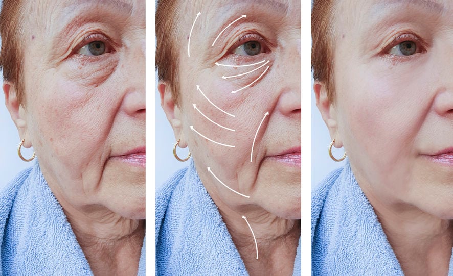 john-park-plastic-surgery-Turn-Back-Time-What-A-Modern-Facelift-Can-Really-Do